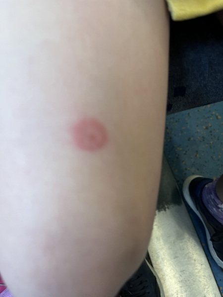 Tick bite with pics