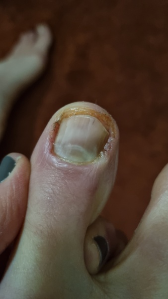 Is this toenail going to fall off?