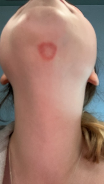 is this ringworm or something else