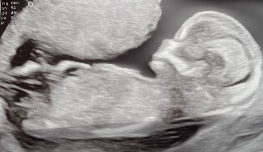 My friends scan (she approved me to do) what do we think she's having?