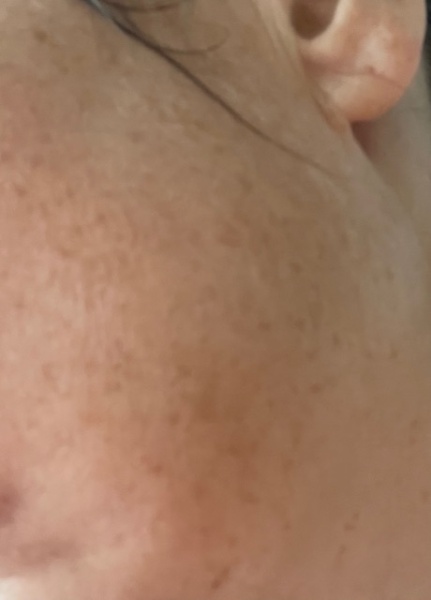 I think I've developed melasma