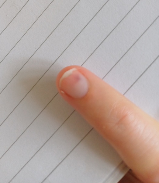 What is this under my fingernail? Worried about tumor (picture included)