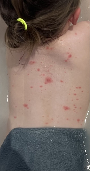 Infected chicken pox