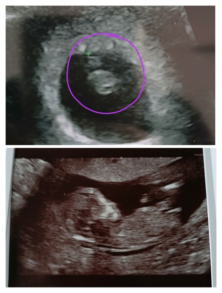 Nub Theory - Boy or Girl?