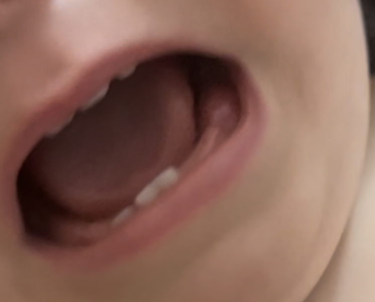 Swollen lump baby’s gum