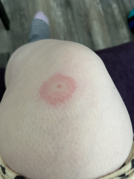 To be freaked out by a tick on my DD!