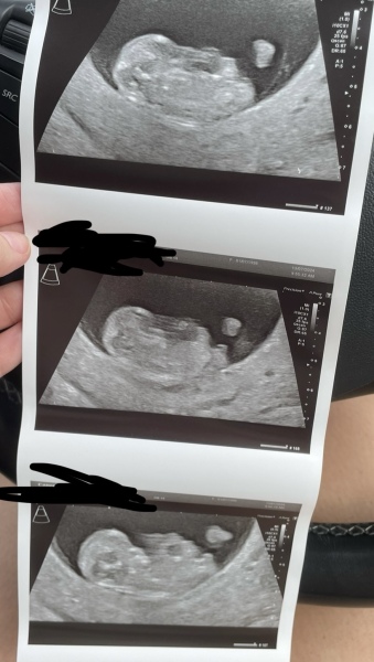 Nub @ 11 weeks? 💖💙