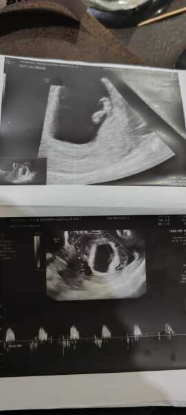 Grab your scans ladies for the...drumroll...Ramzi Placenta Theory!