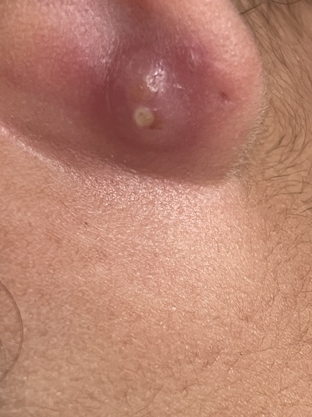 Pussy lump back of ear (pic)