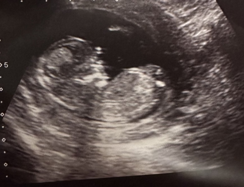 Do you want me to guess the sex? 12 week scans.