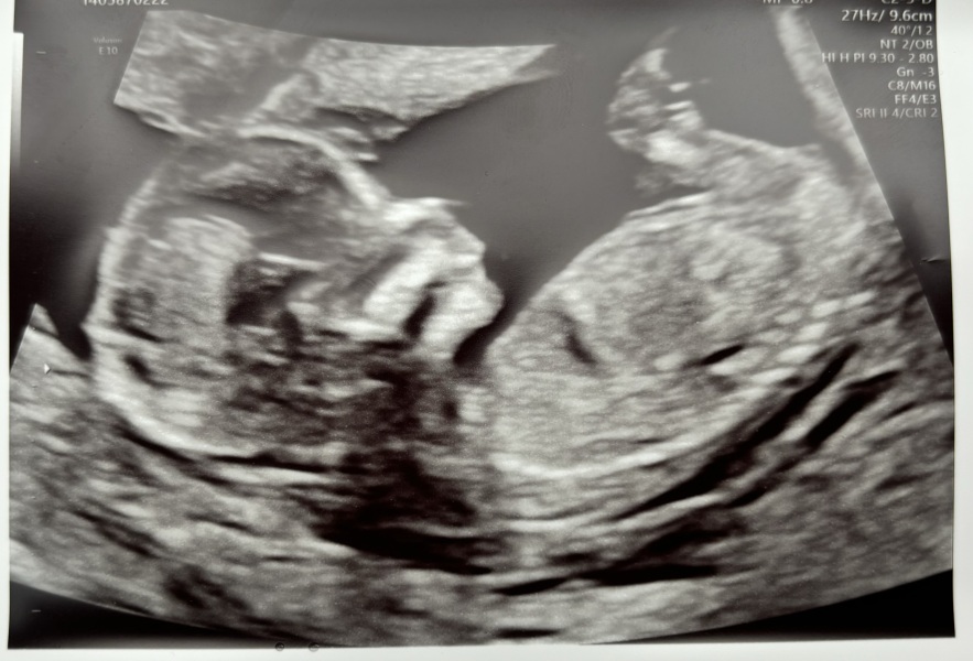 Can anyone take a guess of my babies sex please? 🩷💙