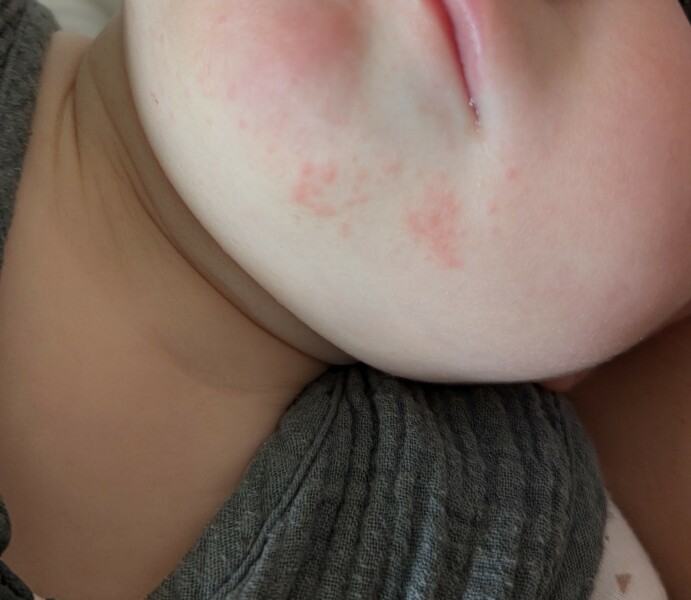 Does this look like an egg allergy?