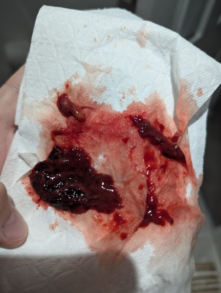 Postpartum blood clots/tissue - TMI pic warning