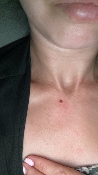 Anyones mole looked a bit flaky and it was ok?