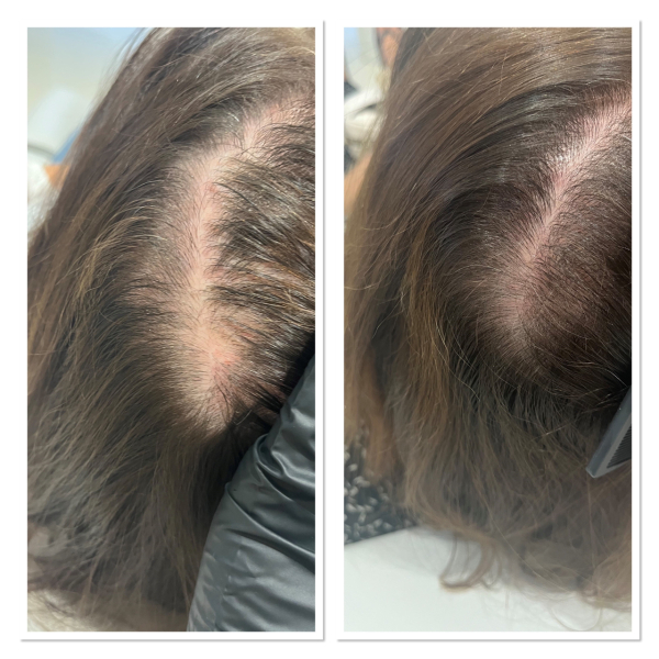 I’m having treatment for hair loss AMA