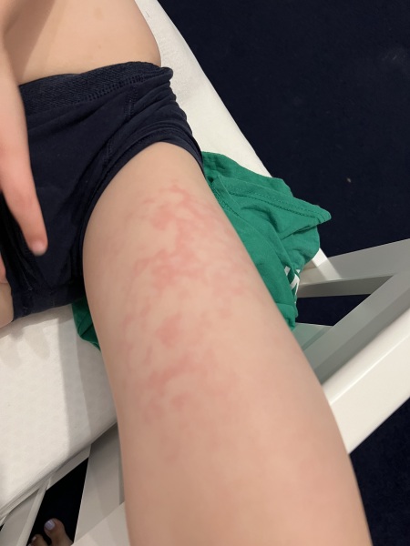 Strange rash coming and going on DS