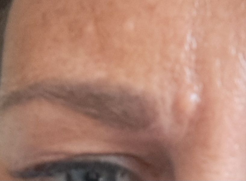 Keloid scar pic attached how to get rid?