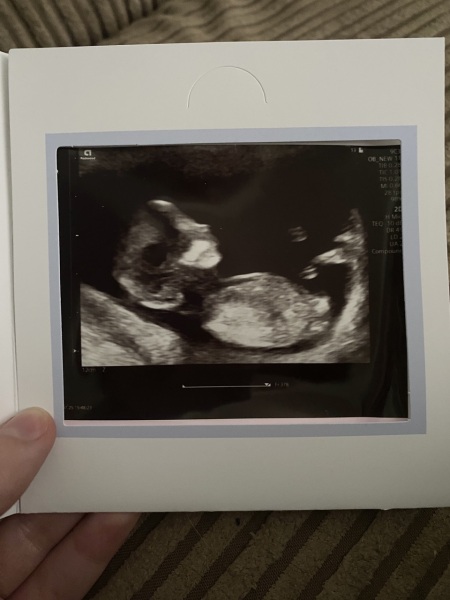 Does anything concern you on my 12 week scan?