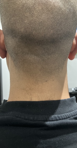 Help ! Lump on DH neck what is it?!