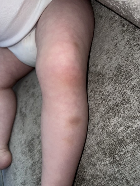Bruises on 15 month old - are they normal?