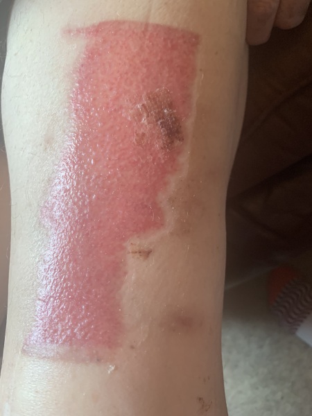 Skin graft - healing question. Advisory - With pic!