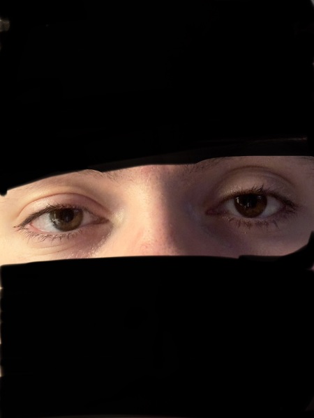 Left upper eyelid bigger than right one