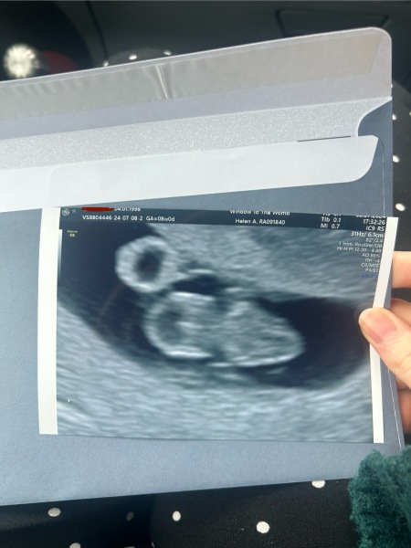 Two miscarriage in a row