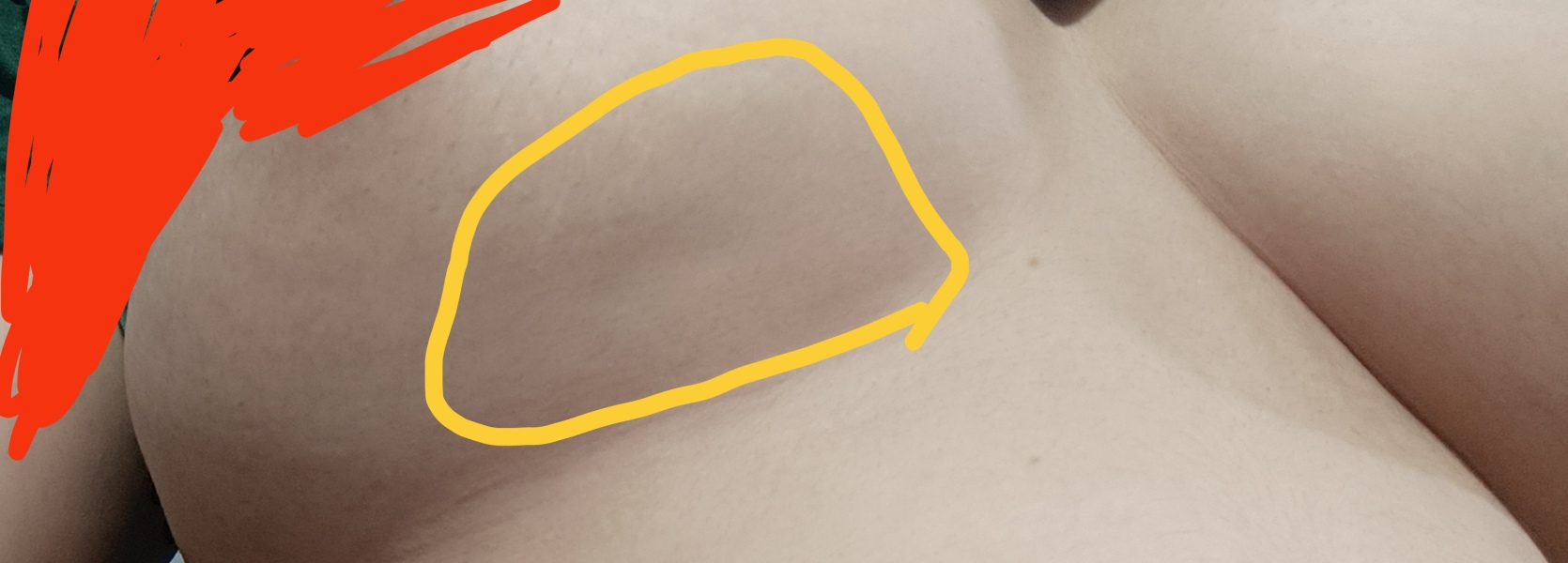 Breast