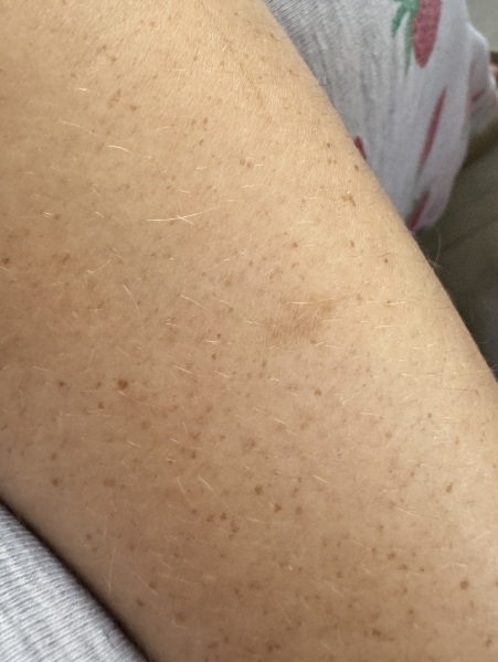 Mole growing? Would you worry?