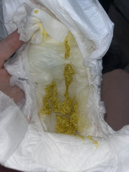 Baby’s pop yellow and seedy? Possible CMPA?