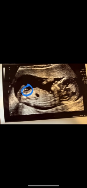 Is this the nub?