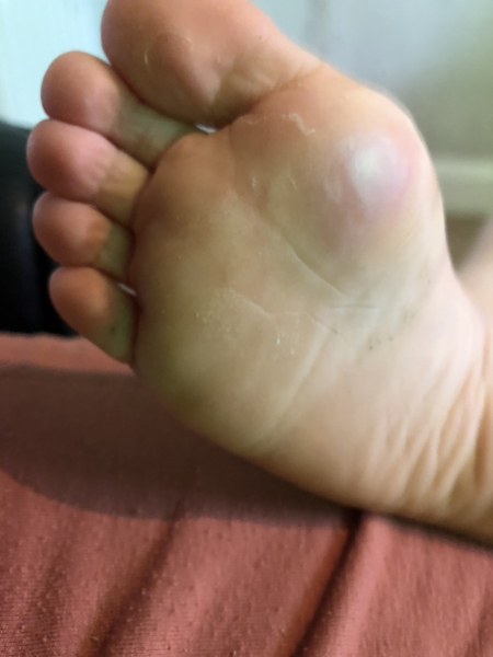 Verrucas - advice needed