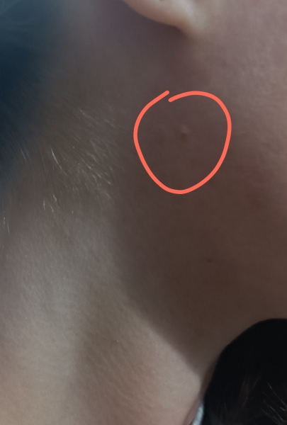 Skin cancer? Anxiety