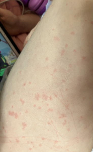 Does this look like chicken pox?