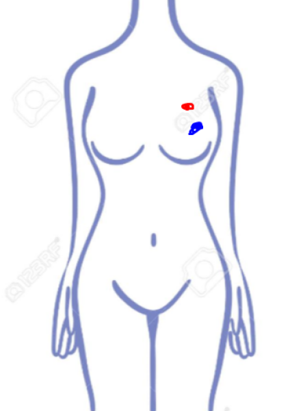 Lump in left breast