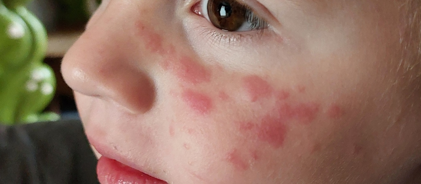 Chicken pox or Molluscum or something else 🤔