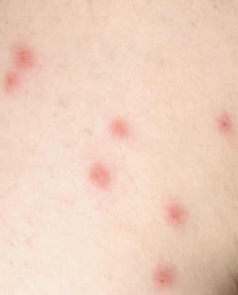 Any ideas what this rash could be?