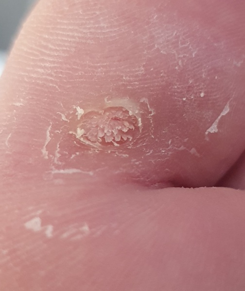 Is this a verruca still?? Picture attached