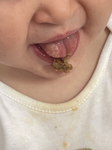 Strange ulcer on tongue?