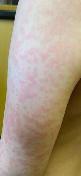 Does this look like chicken pox?
