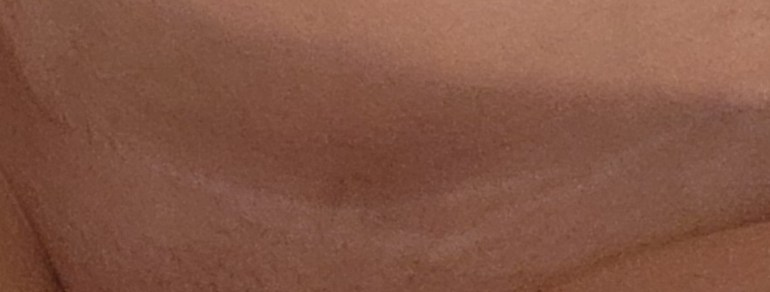 2nd c-section, second scar??