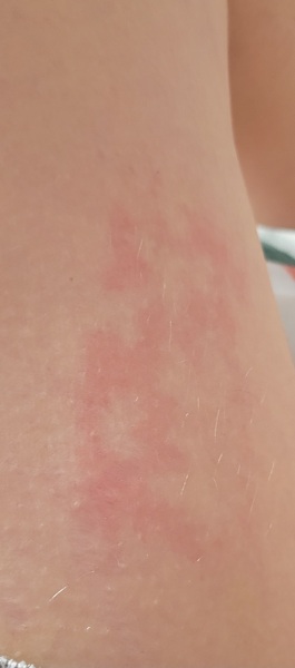 What is causing this rash?