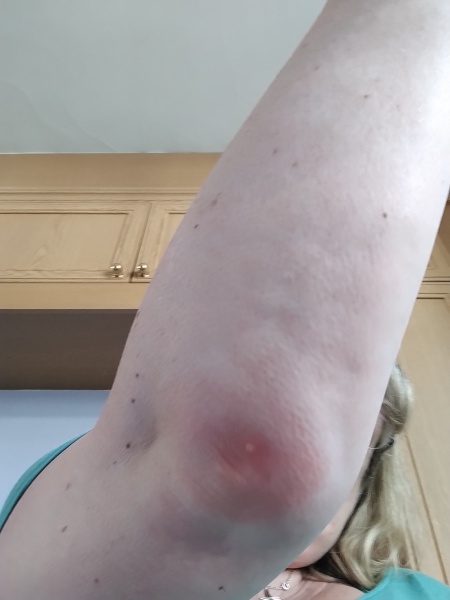 Infected bug bite - antibiotics - 9 weeks (very worried)