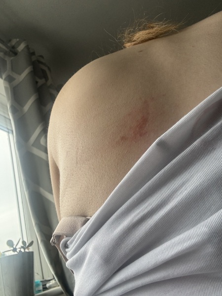 Eczema!? Shingles?!