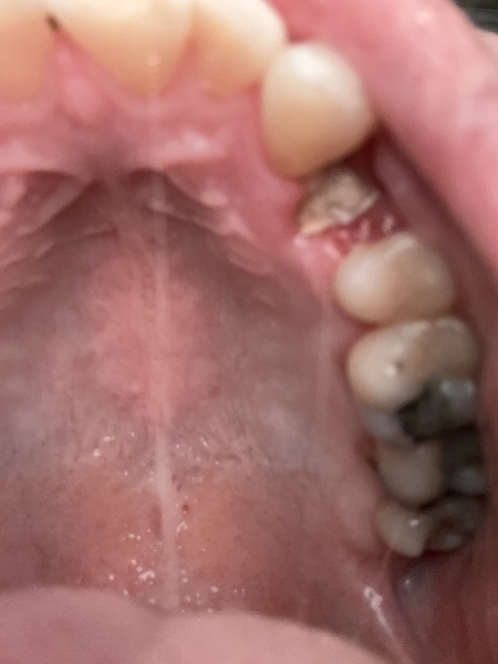Pain still after 5 days of tooth extraction, is this pic normal?