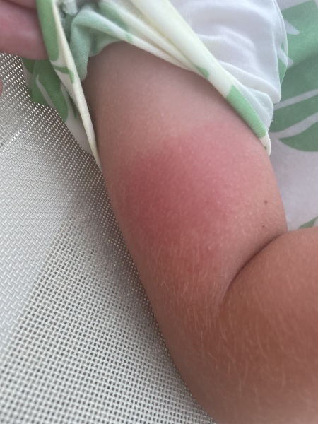 Is this heat rash?!