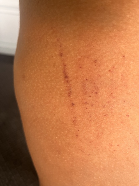 Spider Veins in Legs DPO