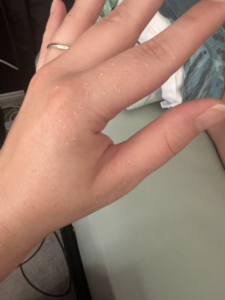 Sebaceous filaments, a romantic sporner story