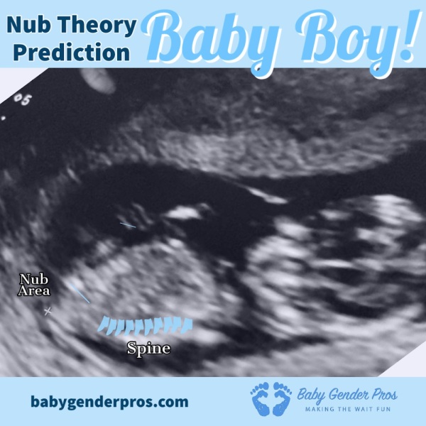 gender girl or boy ultrasound scan