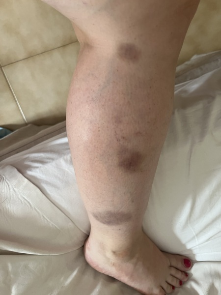 Bruising